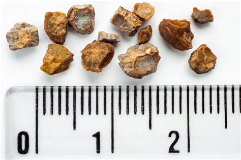 Should I Go to ER for Kidney Stone? And Why Do Rocks Have More Fun?